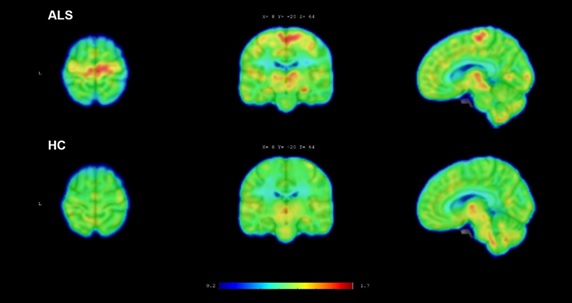 ALS imaging